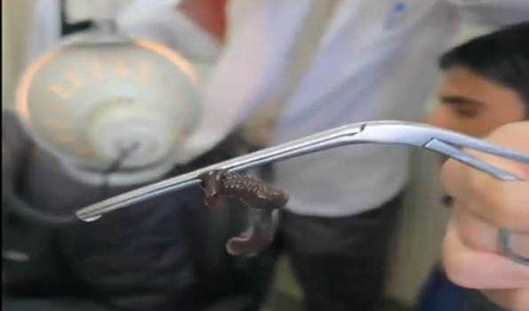 Omg! Doctors Pulled Out Snake-Like Worm From Boy’s Nose in Kashmir